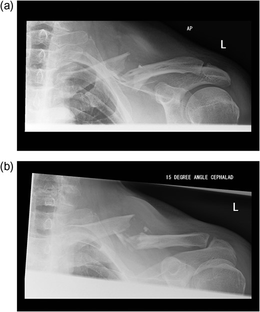 (a and b) Pre-operative radiographs of the fractured clavicle.