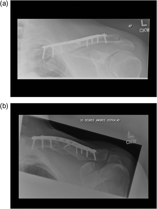 (a and b) Post-operative fixation radiographs.