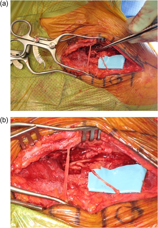 (a and b) Intra-operative pictures demonstrating the intraosseous supraclavicular nerve.
