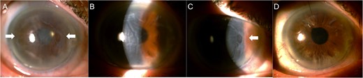 Corneal edema in the right eye as seen before the corneal transplantation (A–C). Some subepithelial fibrotic changes were visible affecting from the periphery to the paracentral area (A and C, white arrows). The visual axis was free of fibrosis (B). Five weeks after excision of subepithelial fibrotic tissue and DMEK, the cornea regained its transparency (D).