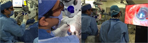 The 3D visualization system's High Dynamic Range (HDR) was attached to the microscope in place of the eyepieces of the surgeon (A, yellow arrow). The surgeon adjusted the zoom and focus directly looking at the screen in front of him, and proceeded to perform surgical maneuvers in that ‘head-up’ position (B). Both the surgeon and the assistant surgeon wore 3D glasses with each lens polarized to make them see a different image through each eye, by filtering out incident light waves at certain angles (one the horizontal and the other the vertical ones), thus enhancing the stereoscopic effect (C).