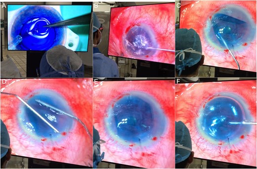 (A) Donor tissue preparation: the double scroll is being aspirated into the injection device. (B) Descemetorhexis. (C) Unfolding of the Descemet graft inside the anterior chamber, with the hinge facing down as confirmed by the Moutsouris' sign. (D) Separation of the scrolls by gentle taps onto the outer cornea. (E) The DMEK roll is almost completely unfolded. (F) The step is completed injecting an air bubble. The images in the screen are not crystal clear since it is necessary to wear the 3D polarized glasses to see them perfectly defined.