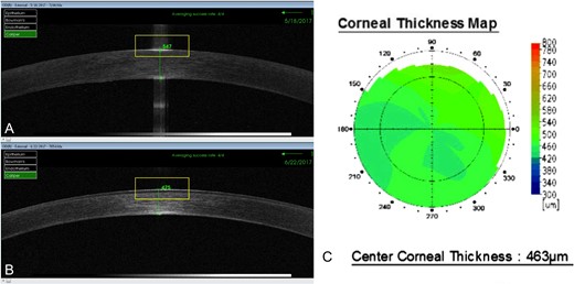 (A) Anterior segment OCT taken the first postoperative day showed that the DMEK endothelial graft was well attached and a central corneal thickness of 547 µ. (B and C) Five weeks later the corneal thickness diminished to between 463 and 475 µ.