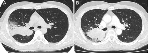 Thoracic computed tomography showing lung tumor before chemotherapy (A) and after chemotherapy (B) in case 1. The tumor increased in size after chemotherapy.