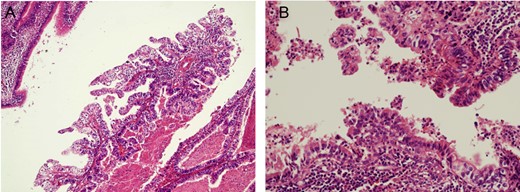 Pathological findings of pneumonectomy specimen in case 1 (H&E): there were components of adenocarcinoma (A, original magnification 200-fold) and immature teratoma (B, original magnification 400-fold).