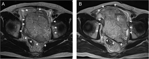 Pelvic MRI showing a large pelvic mass invading to bladder before chemotherapy in case 2 (A). The mass increased in size accompanied with worsening of bladder invasion after chemotherapy (B). Arrow, tumor; BL, bladder.