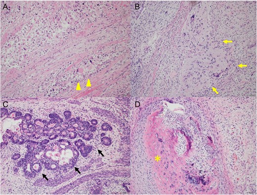 Pathological findings of resected tumor in case 2 (H&E, original magnification 200-fold); there were mixed tumor, consisting of rhabdomyosarcoma (A, arrowhead), glioblastoma (B, yellow arrow), adenocarcinoma (C, black arrow) and mature teratoma (D, asterisk).