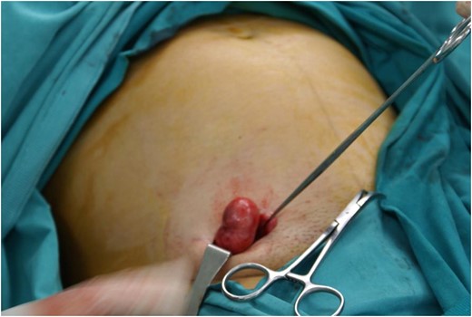 Leiomyoma of round ligament. Intraoperative finding.