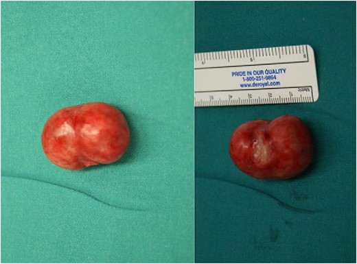 Excised round ligament leiomyoma. Postoperative specimen.