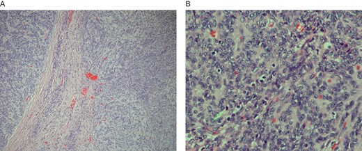 (A) Low-grade vaginal stromal sarcoma: section shows two separate but adjacent tumor nodules with a fibrous septum containing scattered tumor cells. Hematoxylin and eosin stain ×100. (B) High-power microscopic view of low-grade vaginal stromal sarcoma showing spindle and oval-shaped tumor nodules with mild nuclear pleomorphism and many scattered lymphocytes. The arrow head points to a mitotic figure. Hematoxylin and eosin stain × 400.