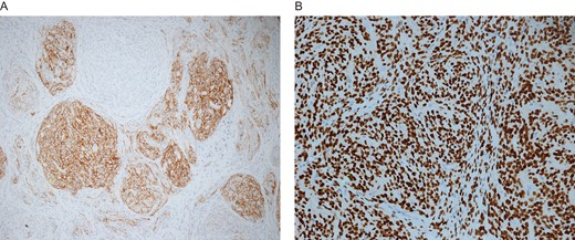 (A) CD10 positive immunohistochemical stain in tumor cells of low-grade vaginal stromal sarcoma. Immunohistochemical stain for CD10 × 100. (B) Strong positive nuclear staining of tumor cells for estrogen receptor marker. Similar pattern of positive nuclear staining was also seen with progesterone receptors. Immunohistochmeical stains for estrogen  × 200.