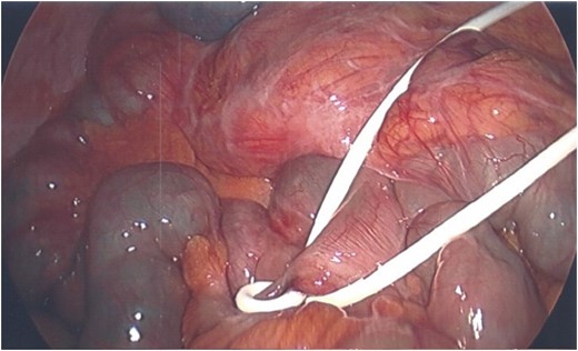 Tubing loop around small bowel.