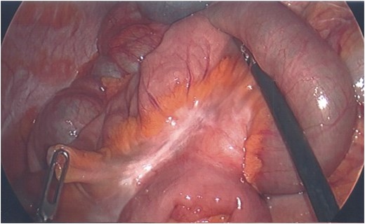 Scarring around small bowel mesentery with viable bowel loop after removal of device.