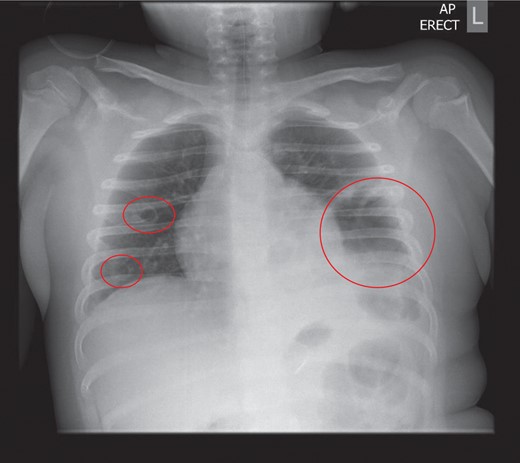 Chest radiograph on admission: a large air filled cavity at the left base. Further small cystic cavities seen medially at the left base and right mid to lower zone.