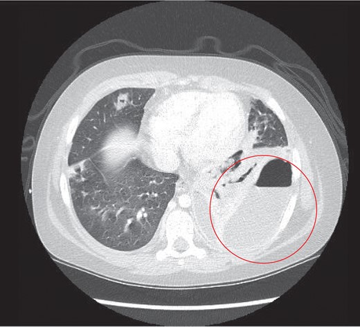 Thoracic CT study the next day, which revealed a large left sided lung empyema with an air fluid level. There was further consolidation and collapse within the left lower lobe and a multiloculated fluid collection.
