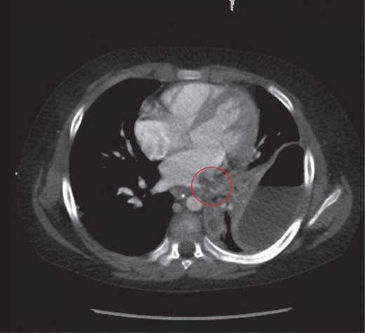 Thrombus noted in the left pulmonary vein extending into the left atrium.