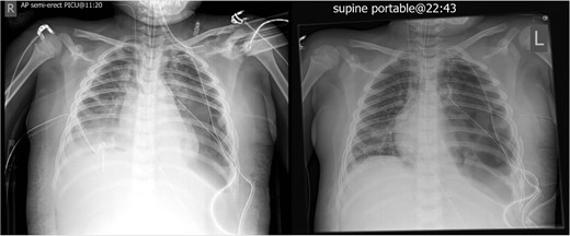 Worsening appearances of the left pneumothorax despite chest drains in situ.