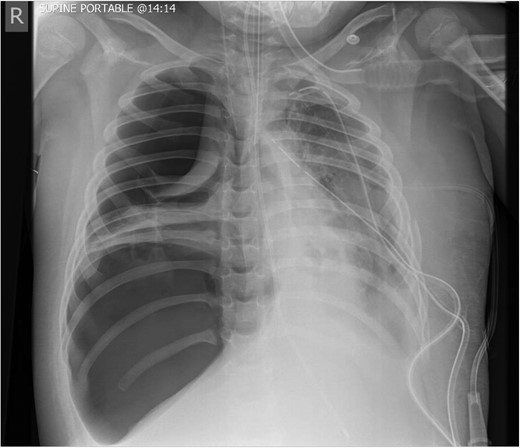 Acute deterioration with right-sided tension pneumothorax.