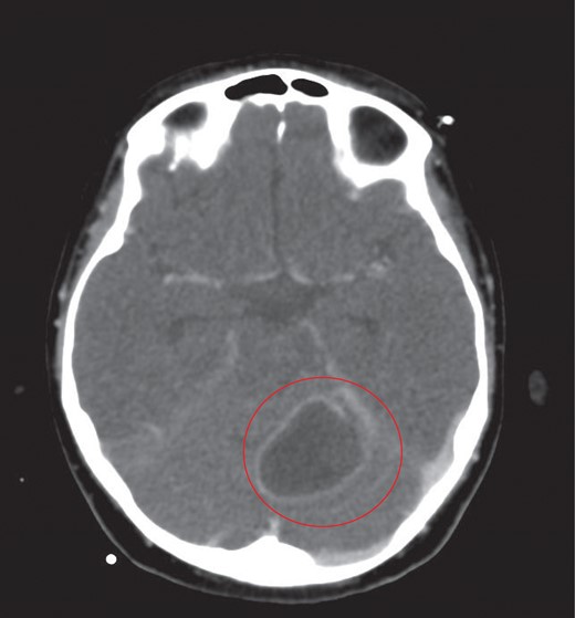 The largest ring enhancing lesion was within the left cerebellar hemisphere. This was drained surgically.