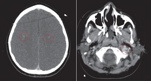 CT scan of head with contrast revealed multiple ring enhancing lesions within the brain, opacification of the left mastoid air cells and thrombus within the superior sagittal sinus and left internal jugular vein.