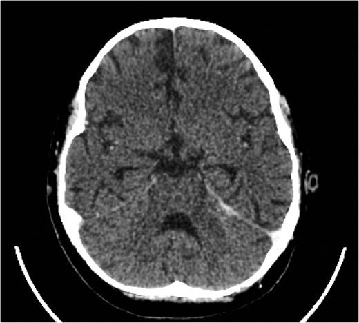 Eventual complete resolution of the brain abscesses and sinus/ IJV thrombosis.