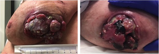 A large fungating mass was found to have ‘ruptured’ through the lateral left breast.