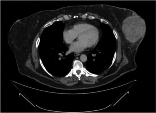 CT scan of the chest demonstrates a 9.2 × 8.6 cm mass within the left breast causing ulceration of the overlying skin.