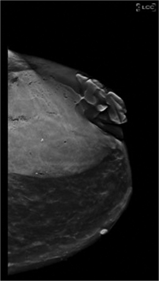 Craniocaudal view of the left breast on mammography demonstrates the extent of the fungating mass.