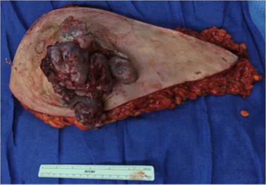 The left breast mass was excised with >2 cm margins in the left breast mastectomy specimen.