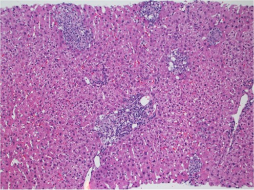 Liver parenchyma with multiple discrete portal and lobular granulomas. Hematoxylin and Eosin stain ×100.