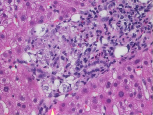 Portal granuloma with histiocytes containing multiple intracytoplasmic yeast-like fungi. Hematoxylin and Eosin stain ×400.