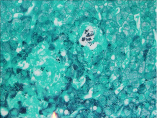 Grocott methanamine silver stain showing yeast-like fungi with narrow-based budding, consistent with histoplasma ×400.