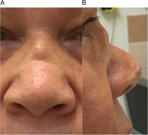 Clinical photographs demonstrating saddle nose deformity with collapse of the nasal dorsum (A) anterior view and (B) lateral view.