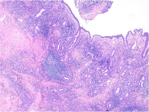 Sinonasal mucosa showing marked chronic inflammation and stromal fibrosis. 40× magnification. H&E.