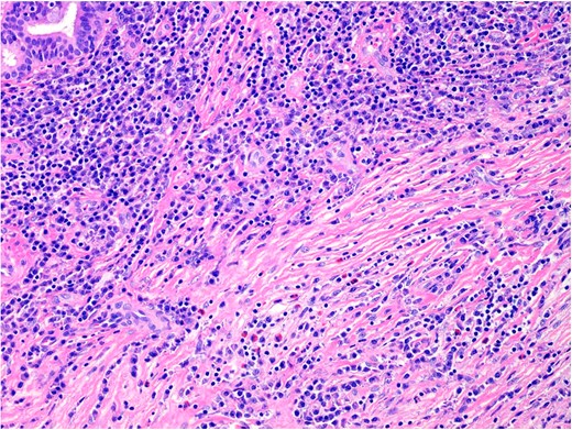 The inflammatory infiltrate is composed of mature lymphocytes, plasma cells and eosinophils. 200× magnification. H&E.