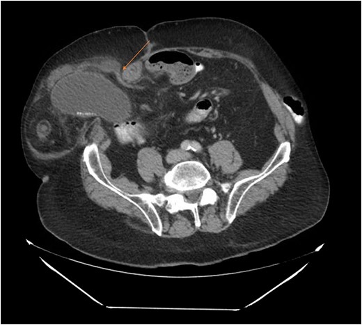 Acute cholecystitis causing a small bowel obstruction within a parastomal hernia. Arrow points to transition point.