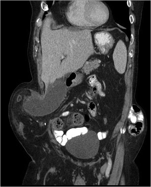 CT from current admission with distended gallbladder consistent with acute cholecystitis.