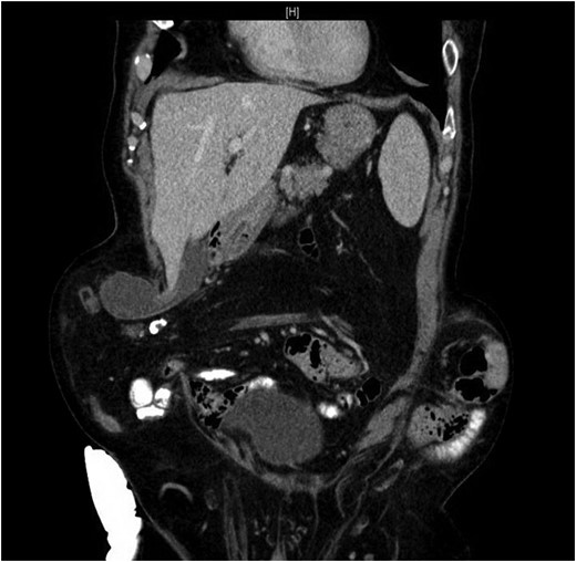 CT from May 2017 with decompressed gallbladder and unobstructed bowel.