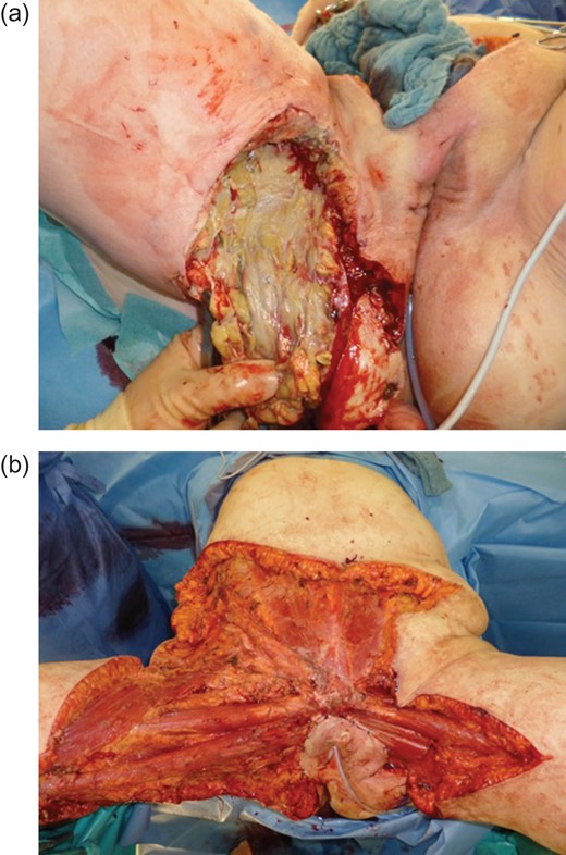 (a) Lytic-necrotic fascias and the subcutaneous soft tissue intraoperatively. (b) Clinical appearance after radical debridement of the infected areas on the first day.