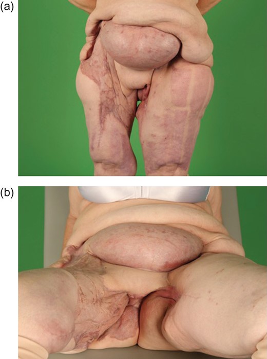 (a) and (b) Stable reconstructive result 5 months postoperatively.