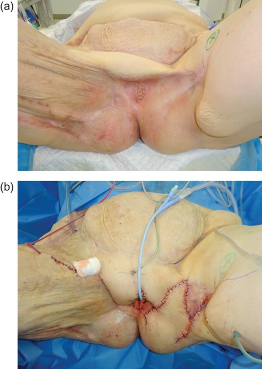 (a) Preoperative findings with clearly visible transverse scars and missing external genitalia (11 months after initial diagnosis). (b) Release of consecutive scarring and plastic reconstruction of the external genitalia.