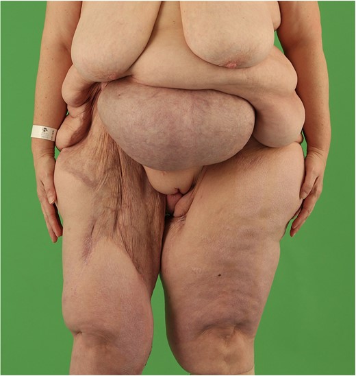 Postoperative result 5 months after last reconstructive procedure.