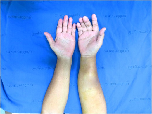 Preoperative picture, tumor located over right forearm.