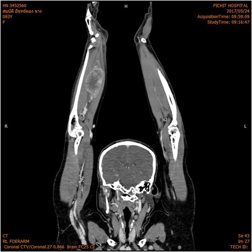 MRI shown hypervascular mass with multiple feeding vessels located in flexure tendon of right forearm.