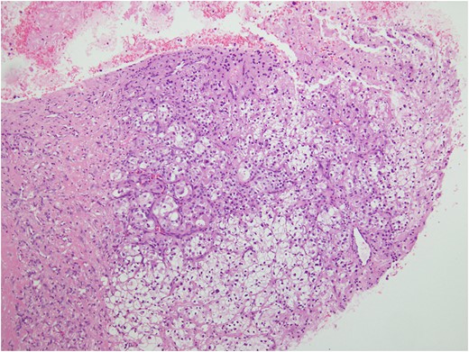 Ultrasound-guided biopsy revealed epithelioid cell neoplasm with clear cell features.