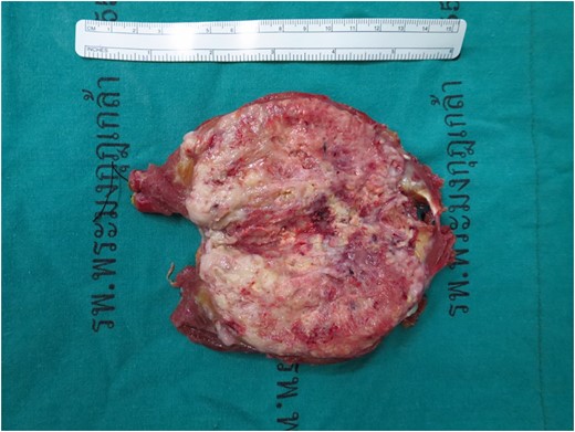 Gross specimen, tumor size 11.5 cm × 5.0 cm × 5.0 cm, a poorly circumscribed, large gray–yellow mass with semi-soft tan homogenous cut surface with large areas of hemorrhage and necrosis.