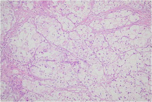 Tumor cells are arranged in organoid or nesting pattern. The nests are vary in size and shape and are separated by delicate thin fibrous septa containing vascular channels.