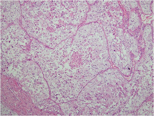Loss of cellular cohesion and necrosis of the centrally located cells in the nests.