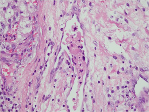 Vascular invasion by tumor cells.