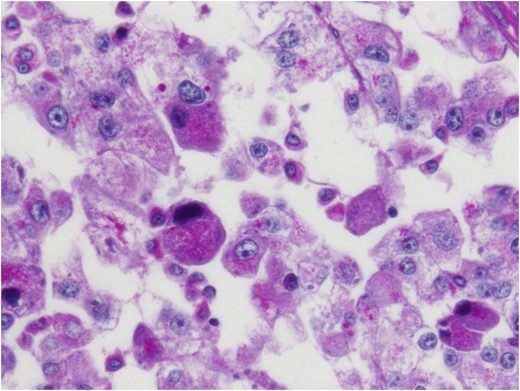 Crystalline inclusions demonstrated with periodic acid-Schiff stain after diastase digestion.
